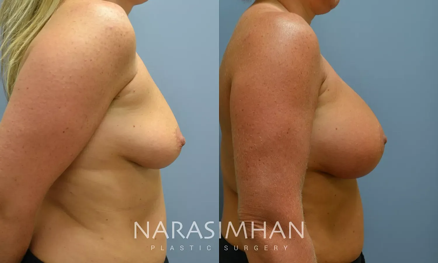Breast Augmentation Before & After