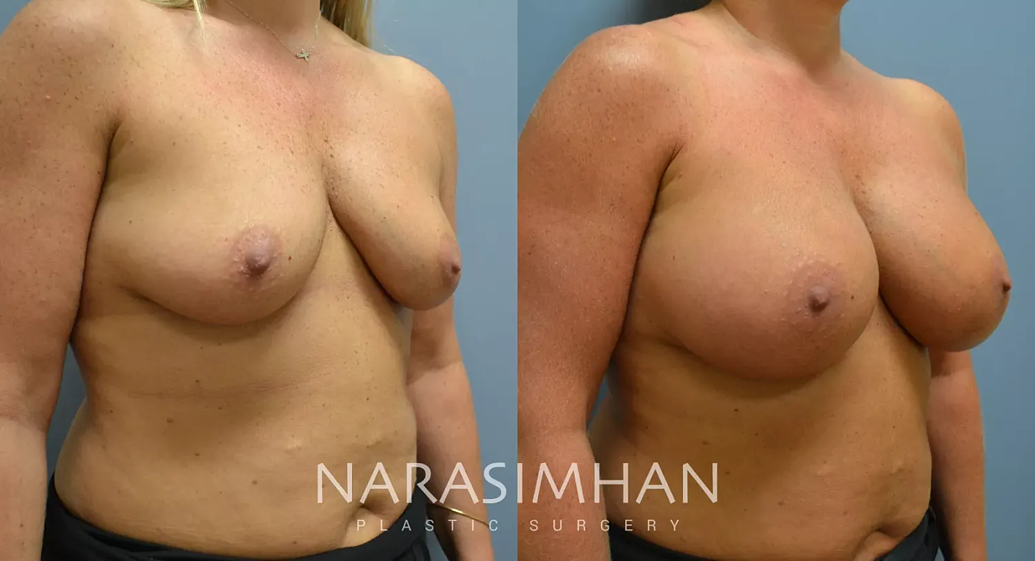 Breast Augmentation Before & After