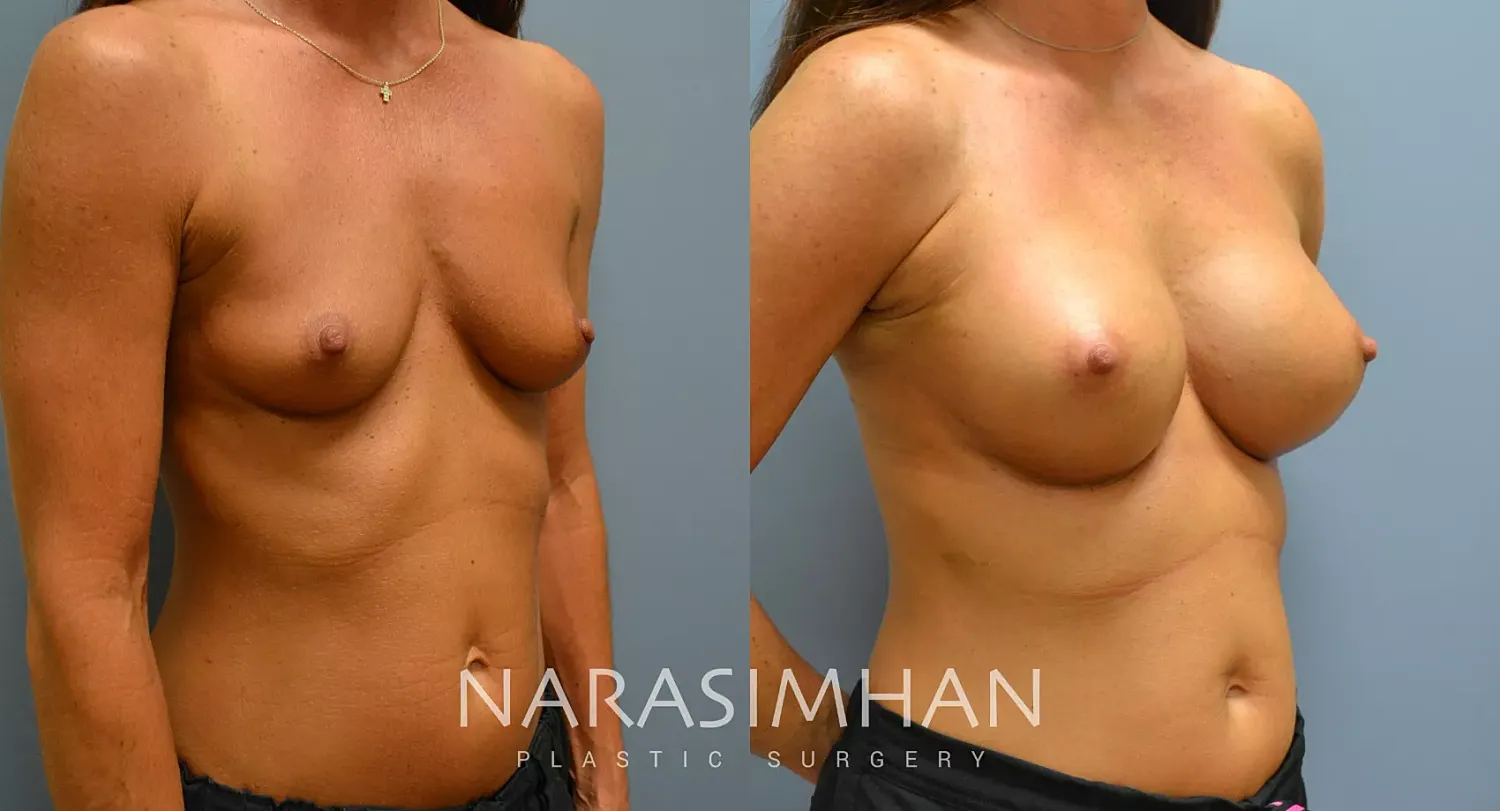 Breast Augmentation Before & After