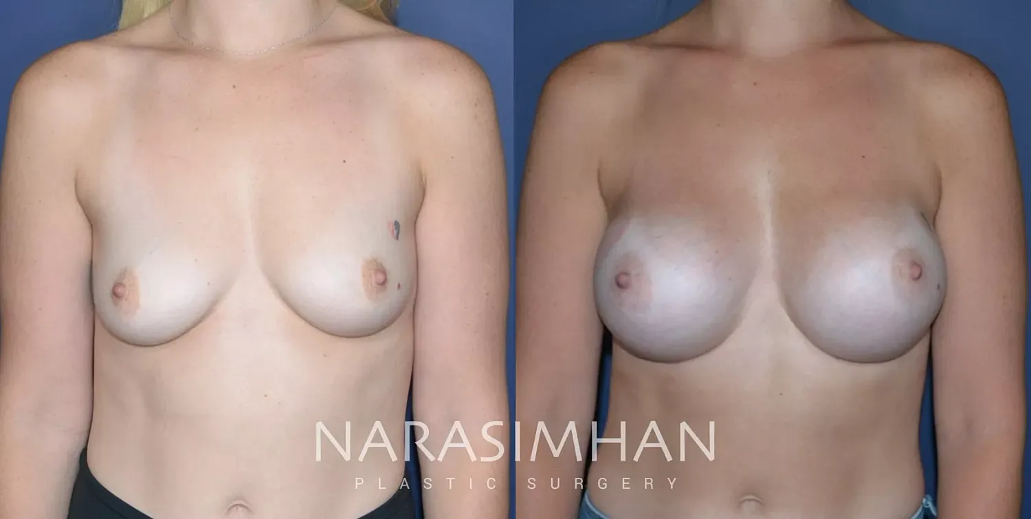Breast Augmentation Before & After