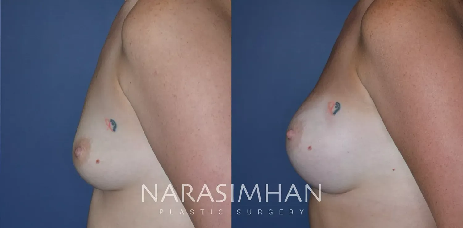 Breast Augmentation Before & After