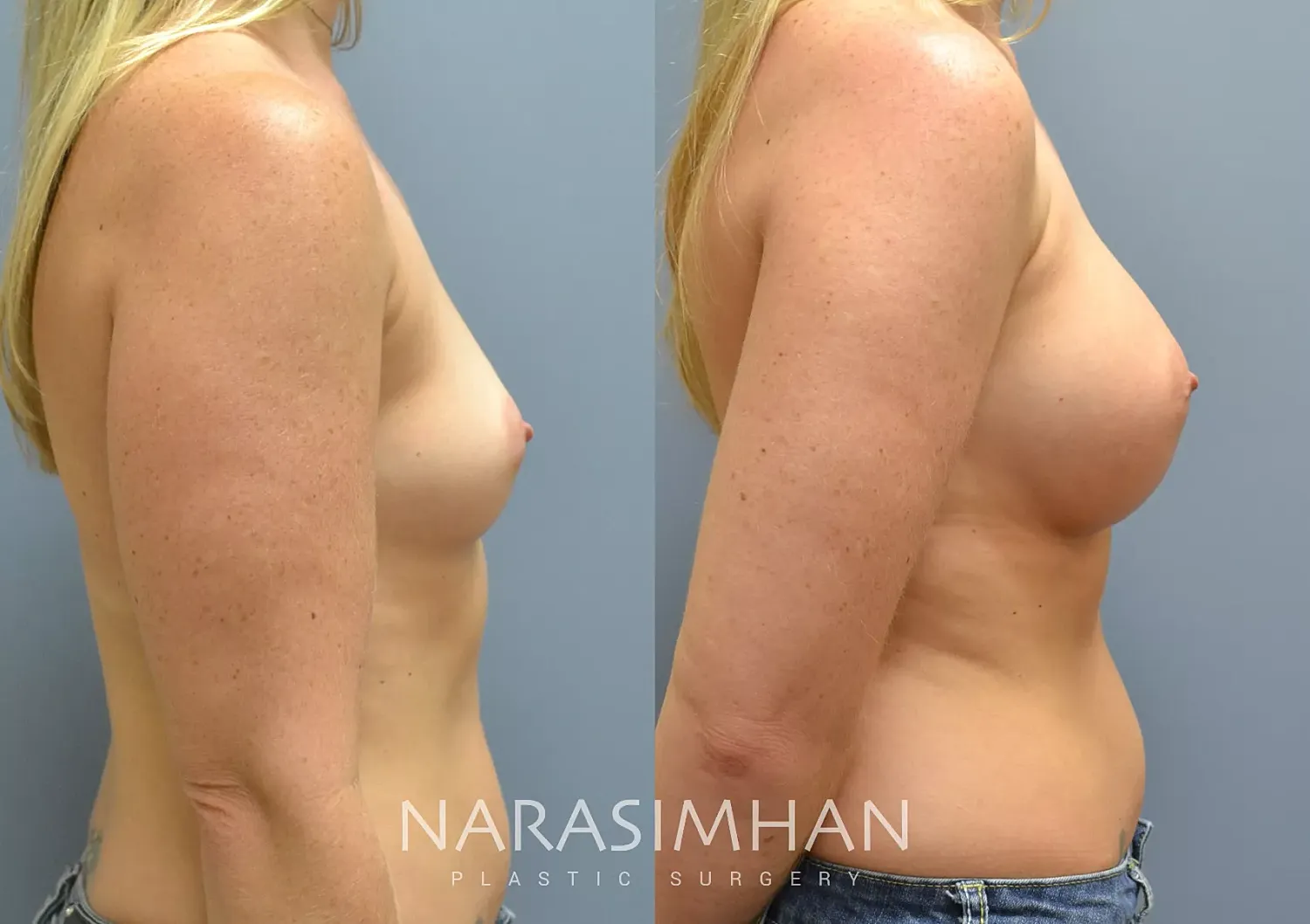 Breast Augmentation Before & After