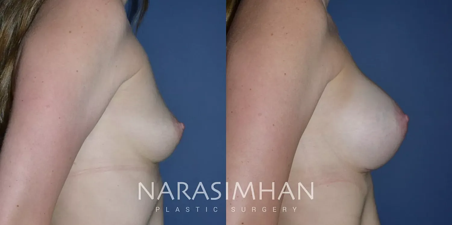Breast Augmentation Before & After