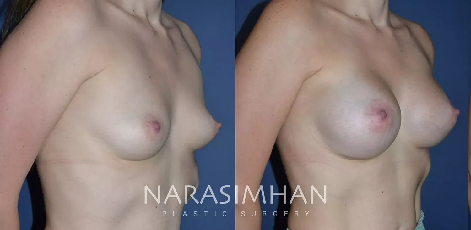 Breast Augmentation Before & After