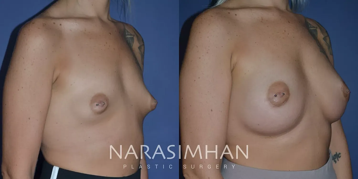 Breast Augmentation Before & After