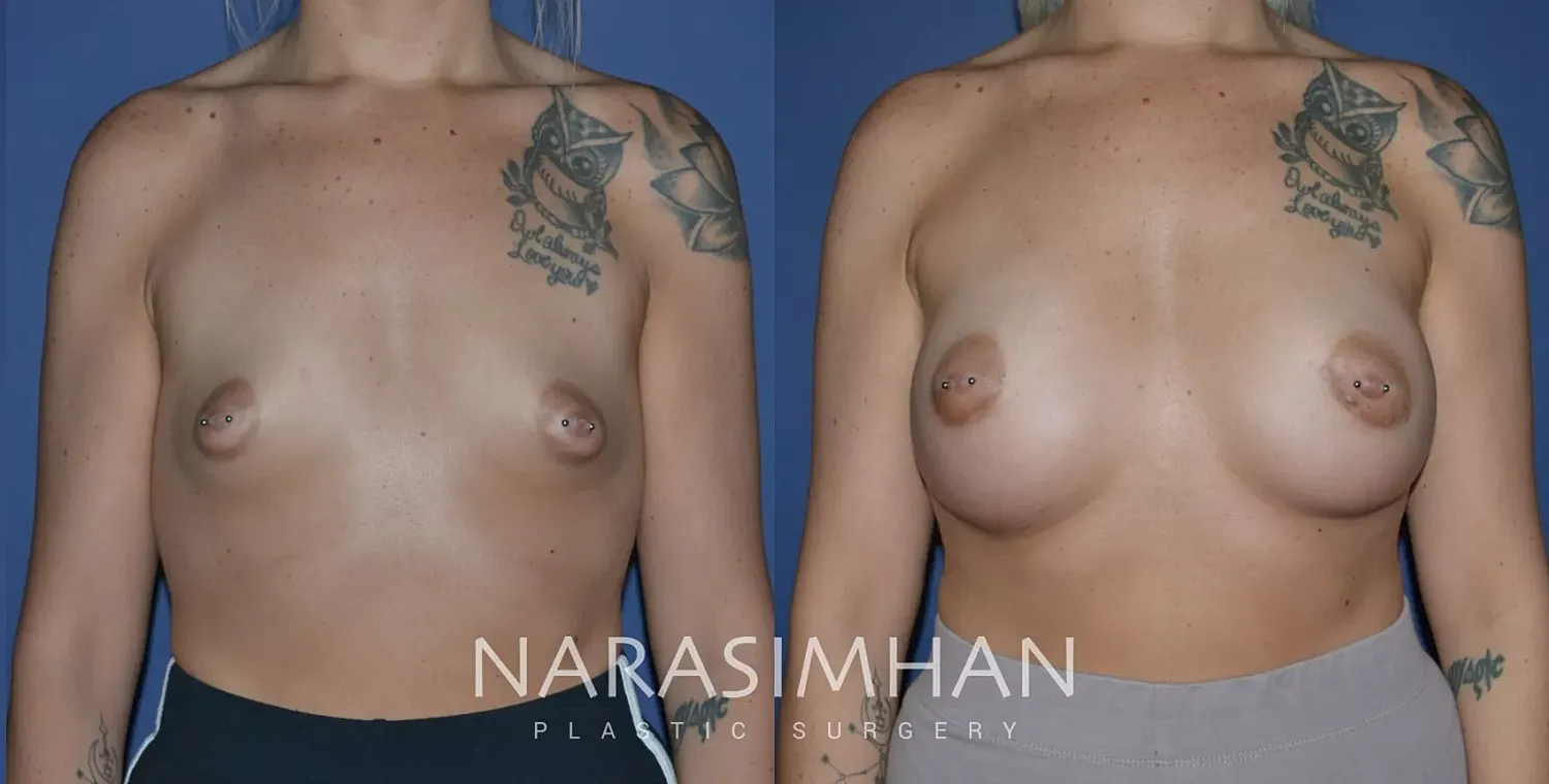 Breast Augmentation Before & After