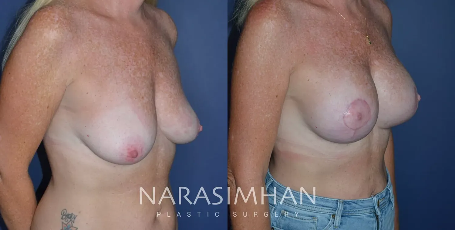 Breast Augmentation Before & After