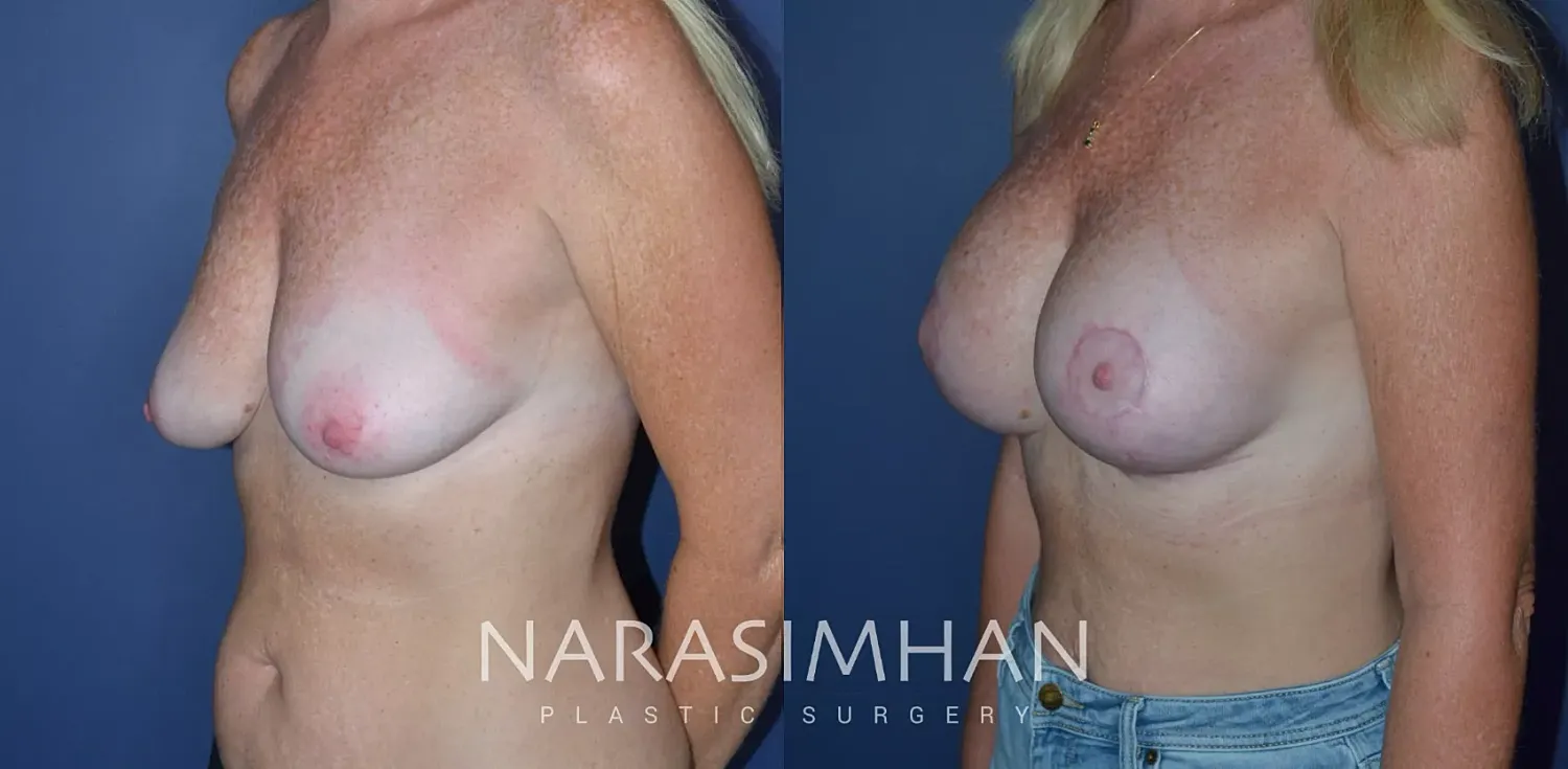 Breast Augmentation Before & After