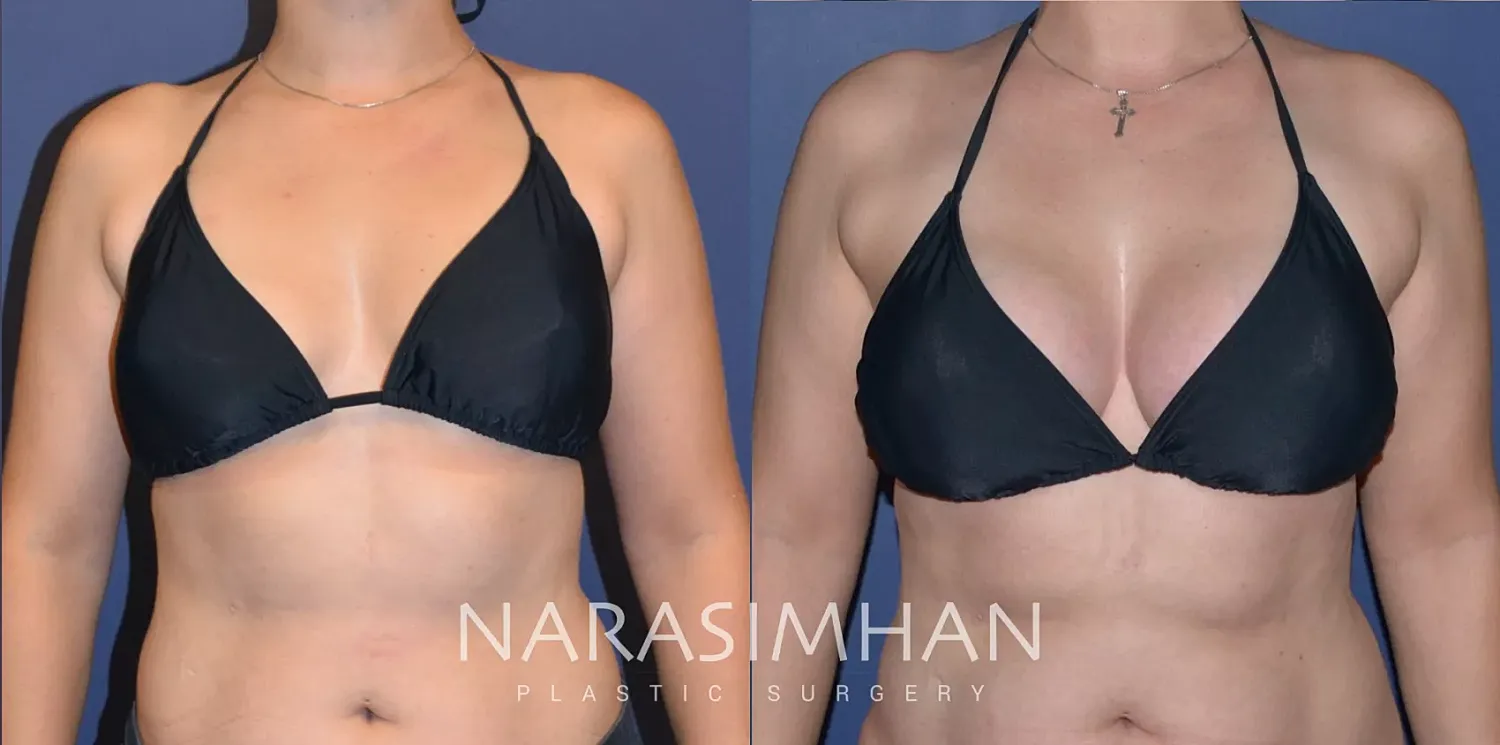 Breast Augmentation Before & After