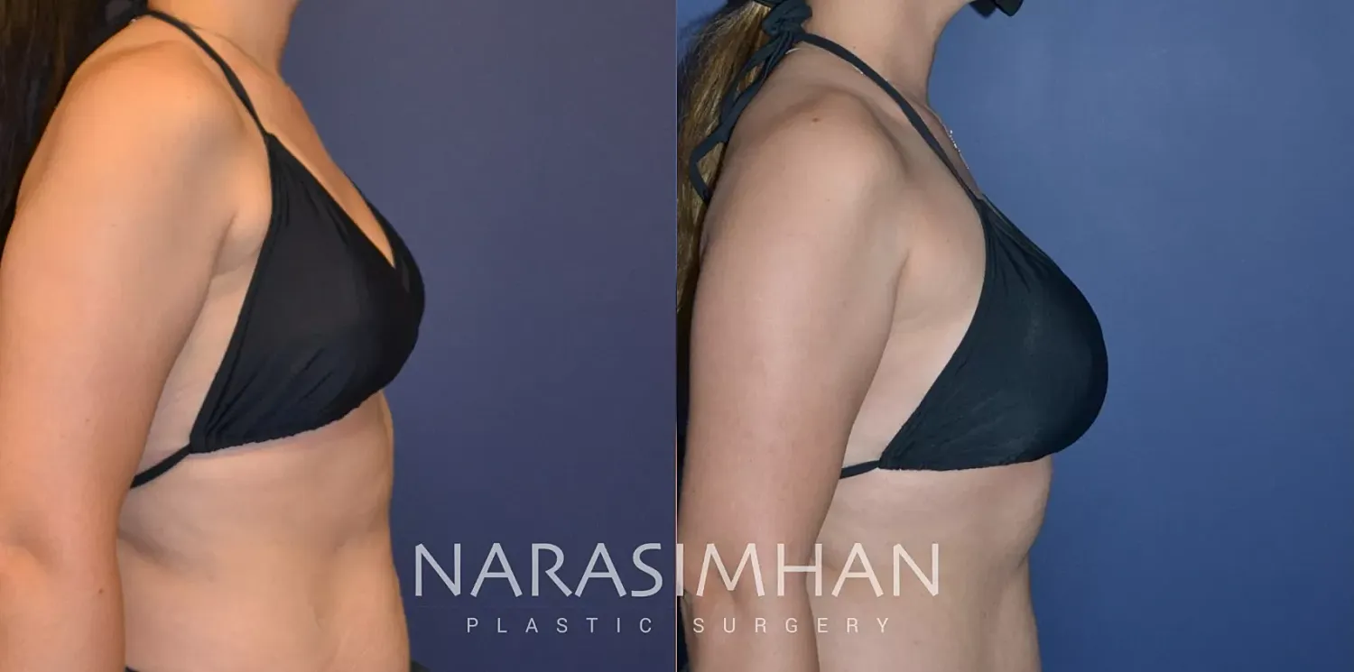 Breast Augmentation Before & After