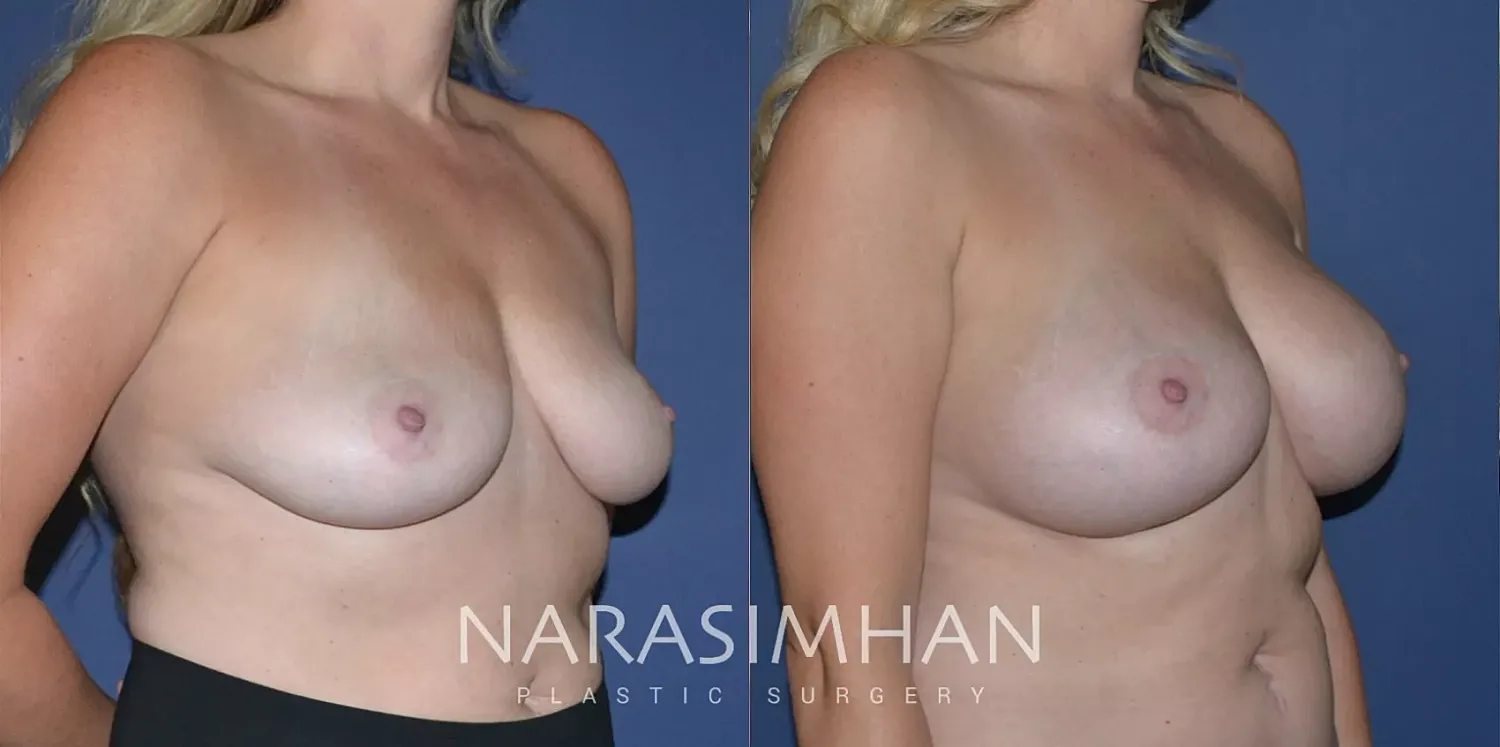 Breast Augmentation Before & After