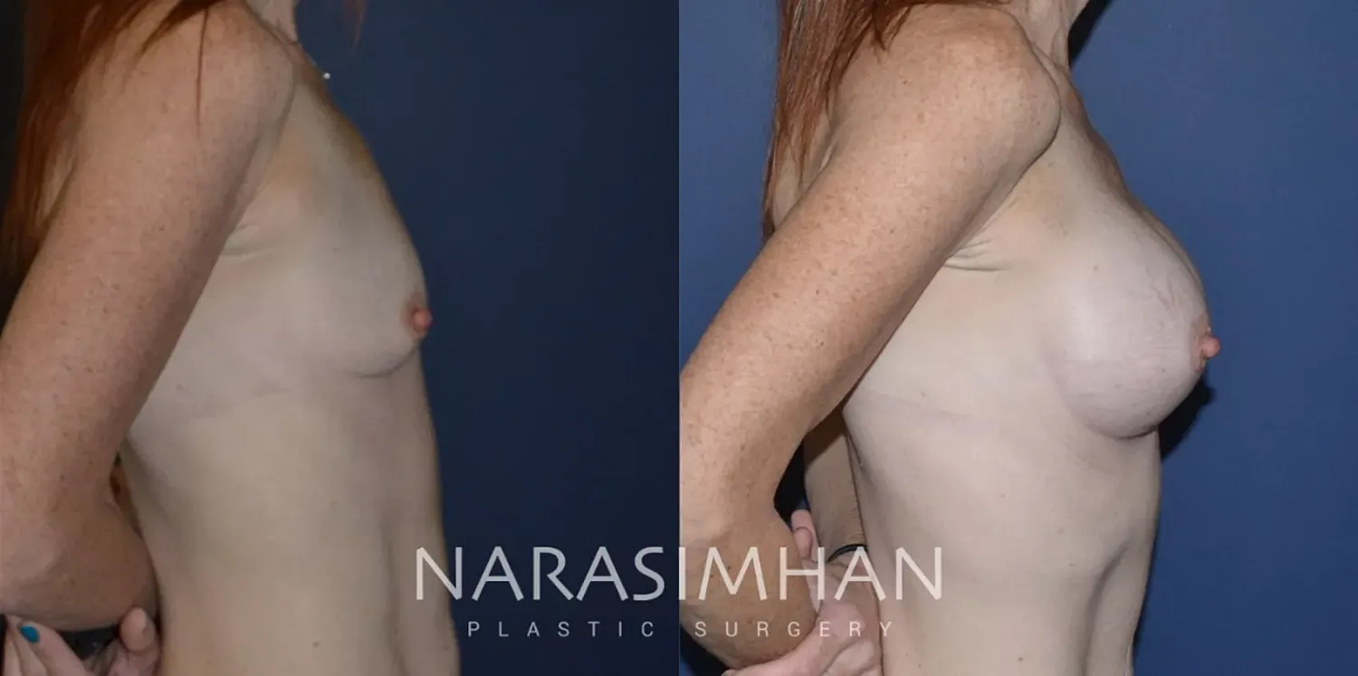 Breast Augmentation Before & After
