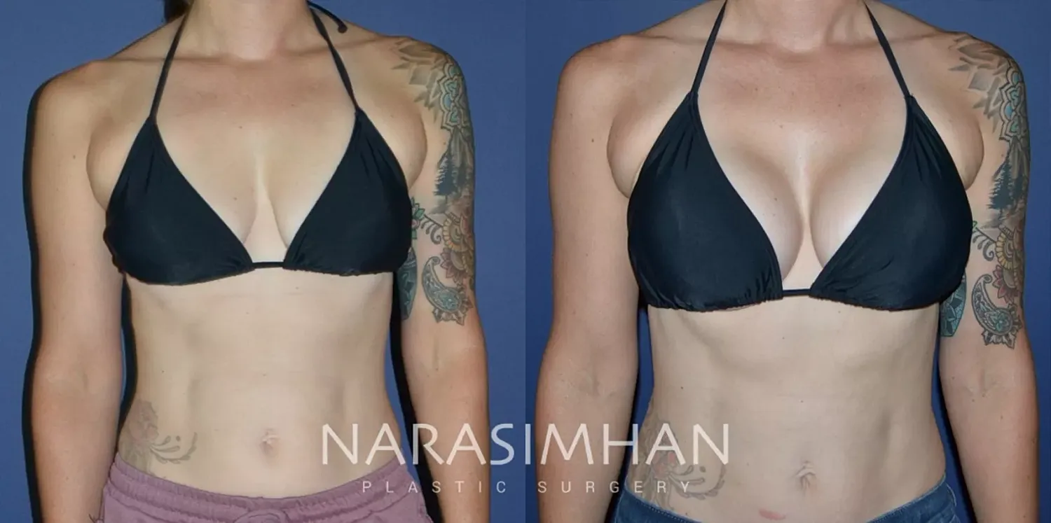 Breast Augmentation Before & After