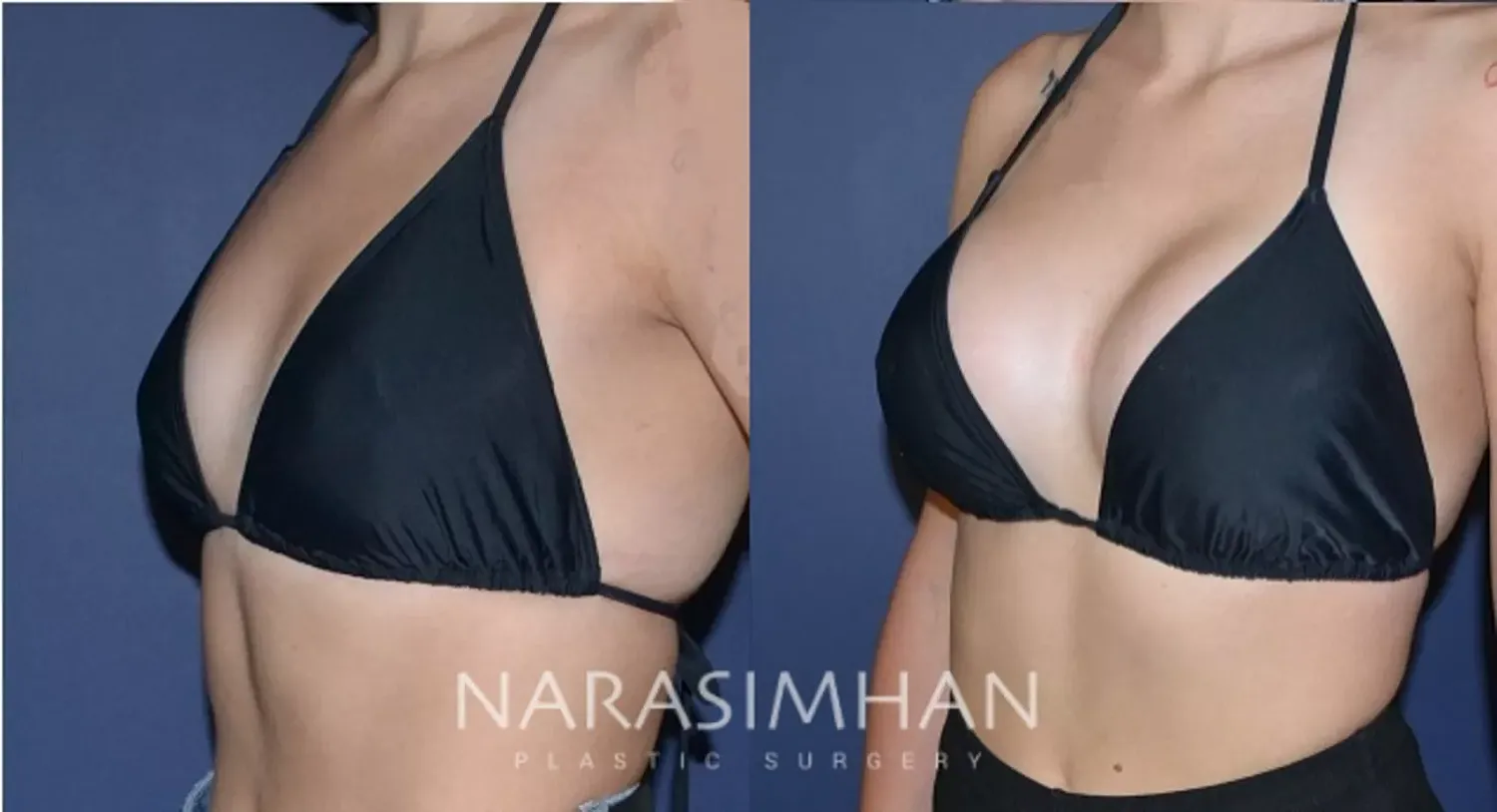Breast Augmentation Before & After