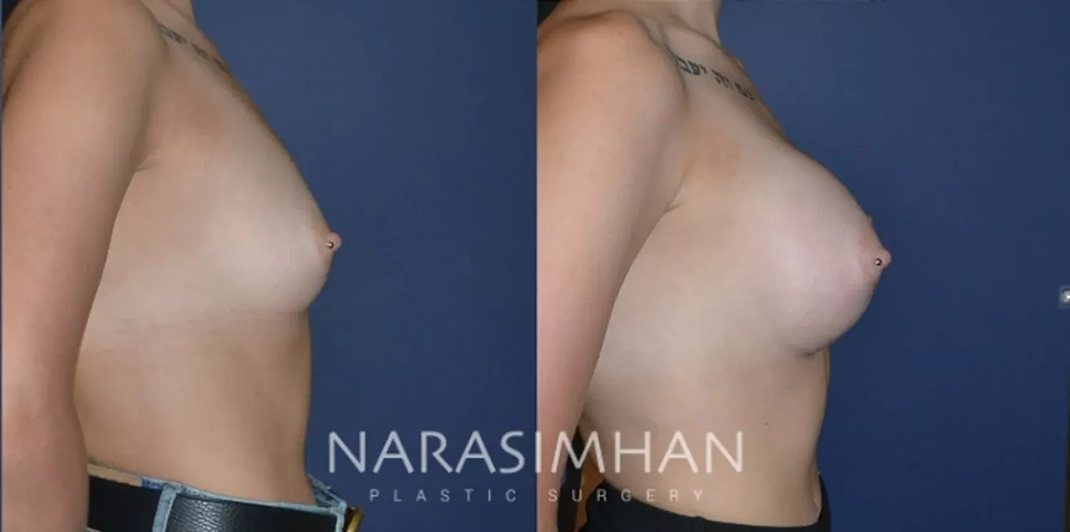 Breast Augmentation Before & After
