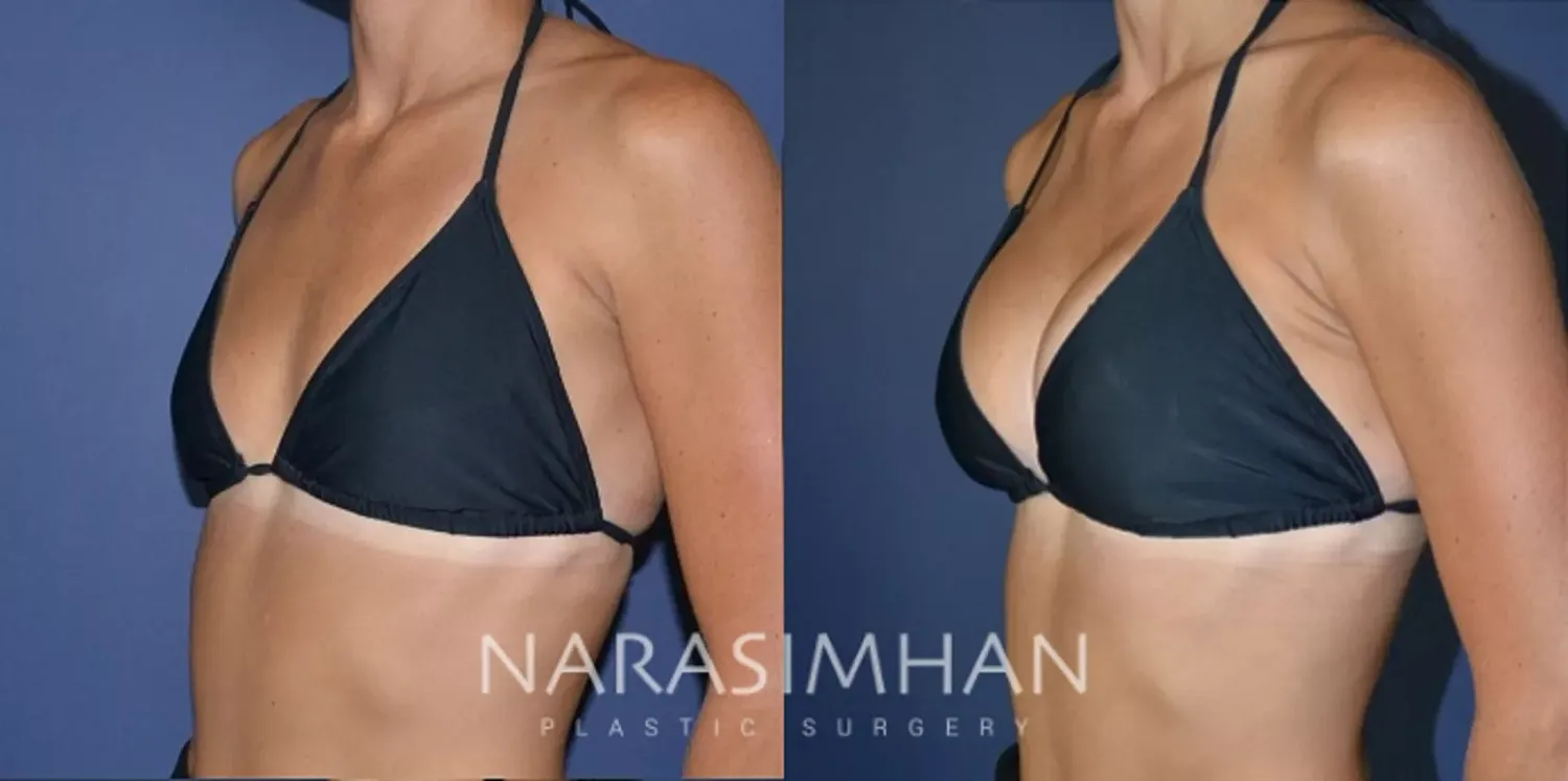 Breast Augmentation Before & After