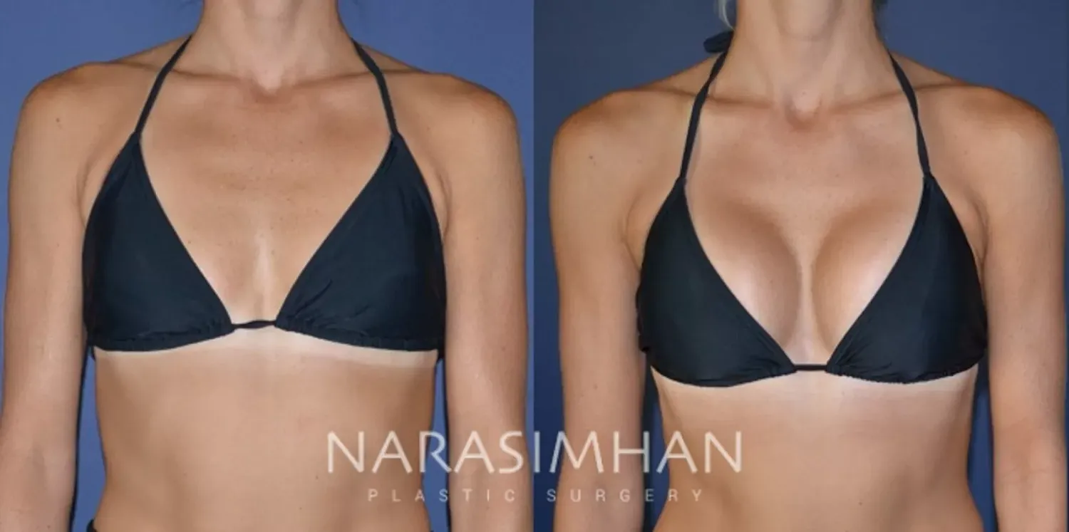 Breast Augmentation Before & After