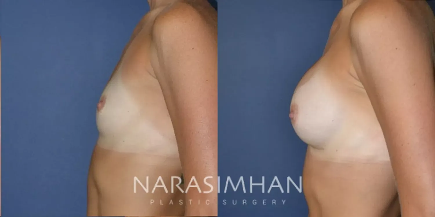 Breast Augmentation Before & After