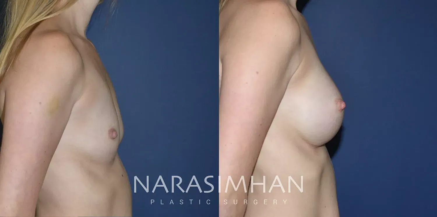 Breast Augmentation Before & After