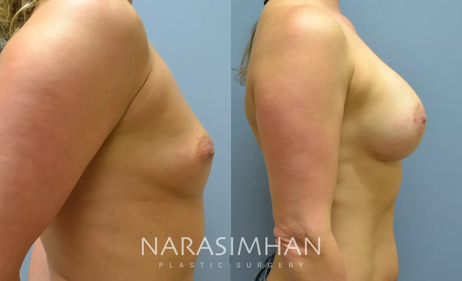 Breast Augmentation Before & After