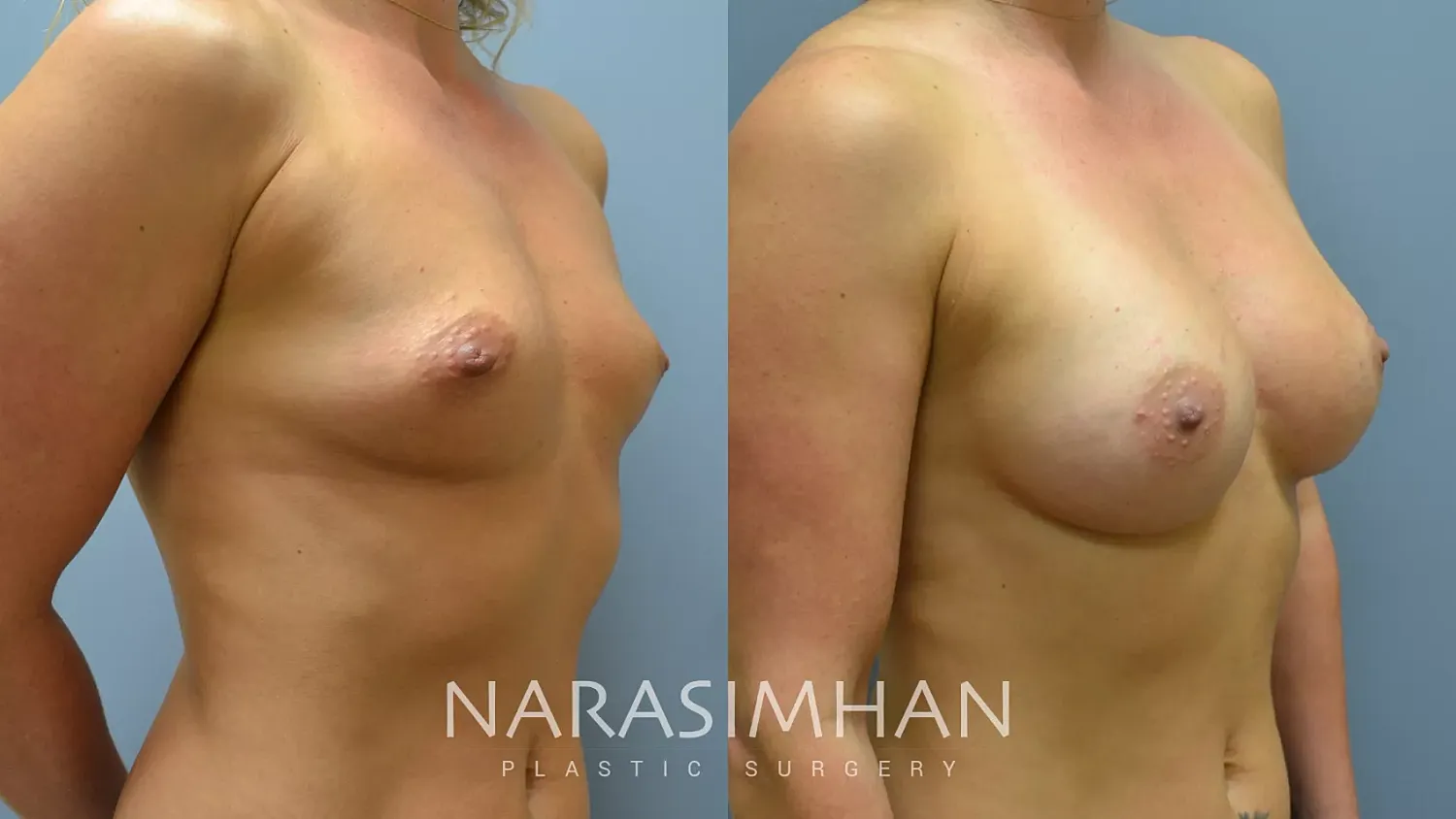 Breast Augmentation Before & After