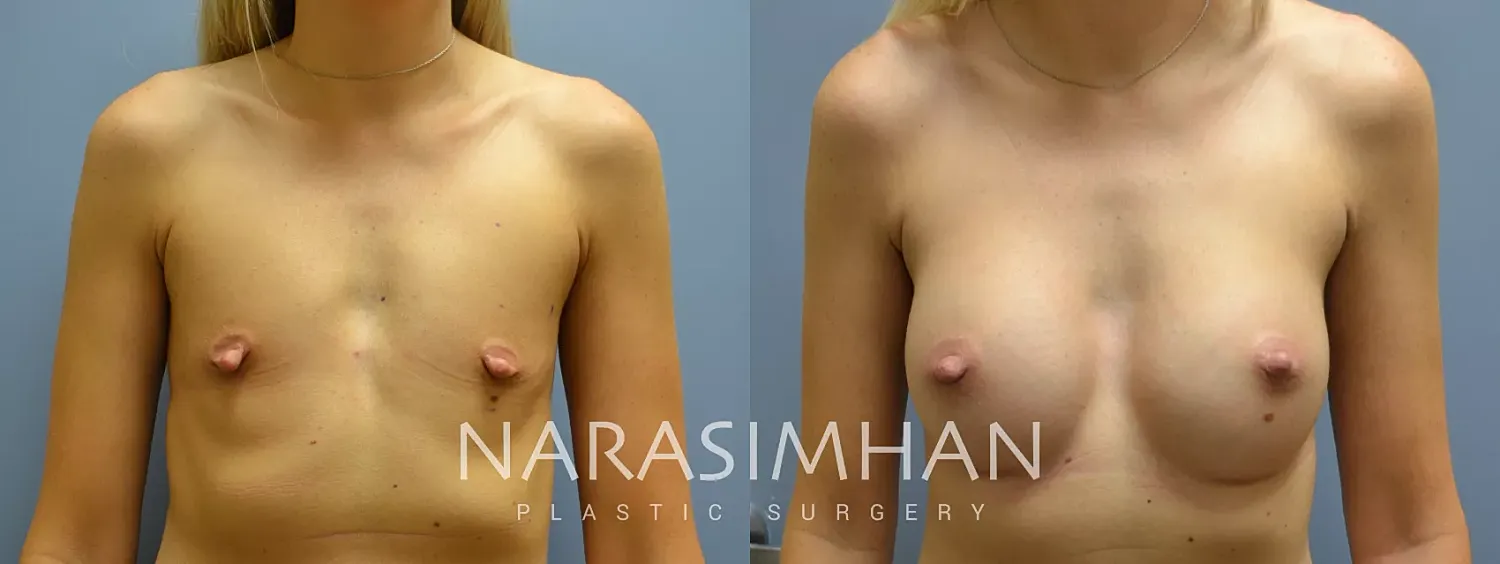 Breast Augmentation Before & After