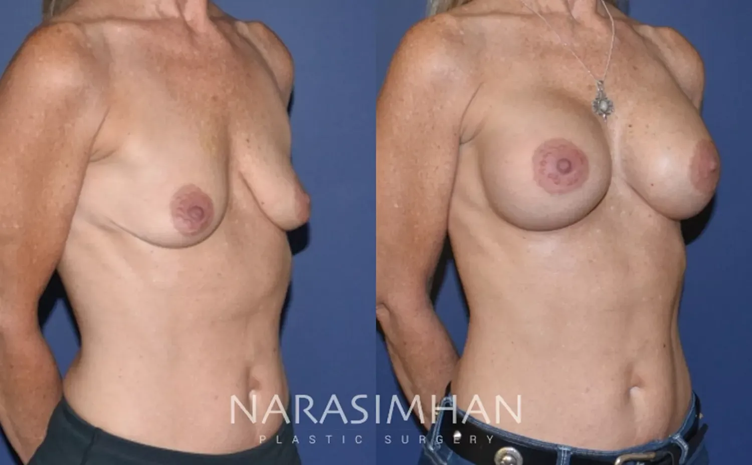 Breast Augmentation Before & After