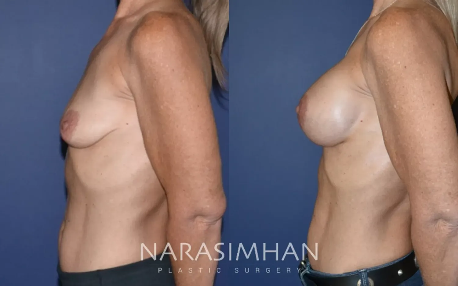 Breast Augmentation Before & After