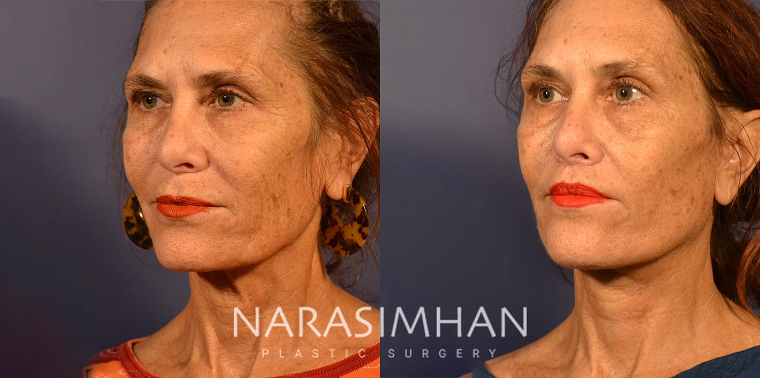 Brow Lift Before & After