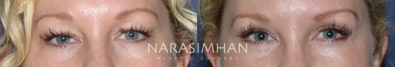 Brow Lift Before & After