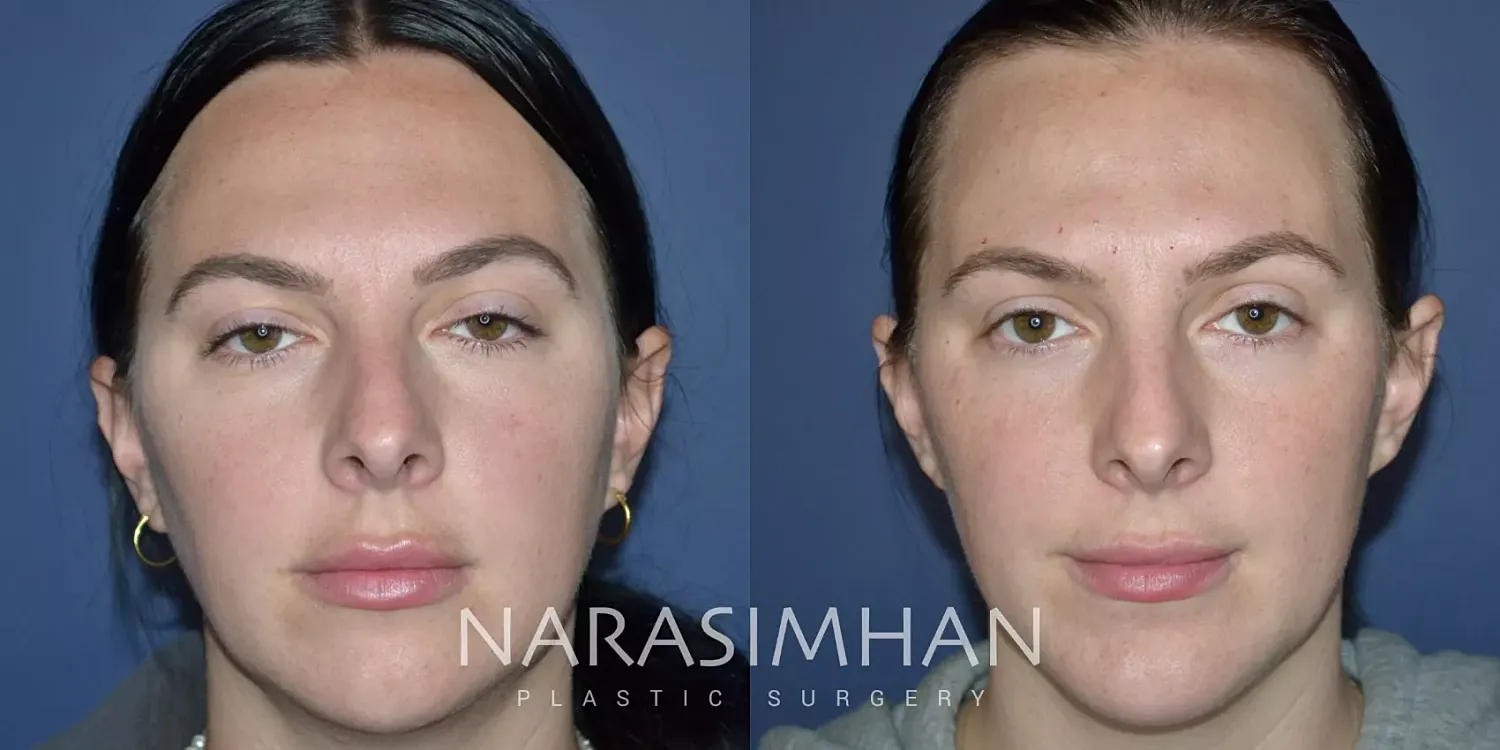 Chin Augmentation Before & After