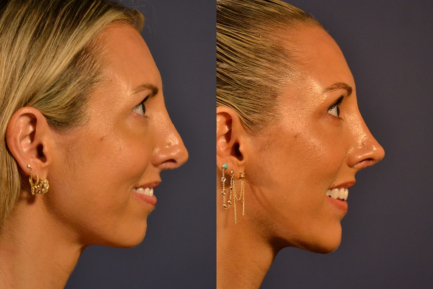 Side profile comparison of two women.