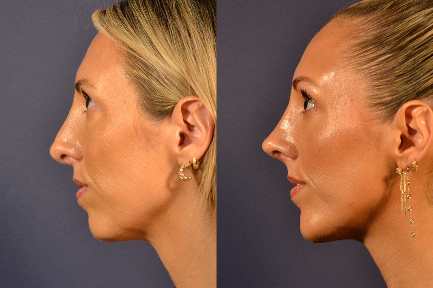 Profile comparison of two women's faces.