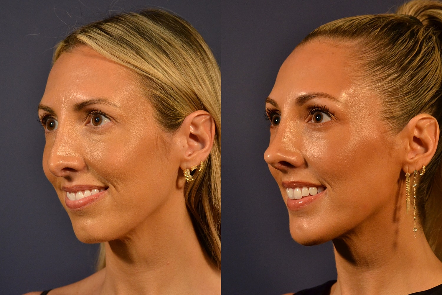 Side profile comparison of woman with earrings.