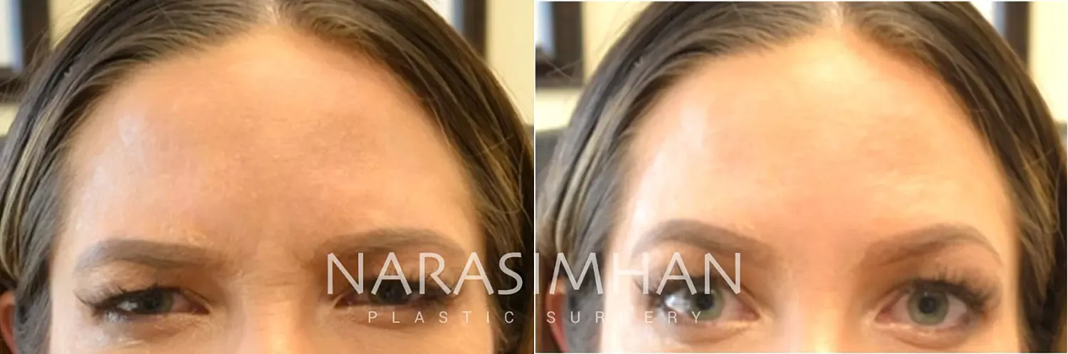 Botox Before & After