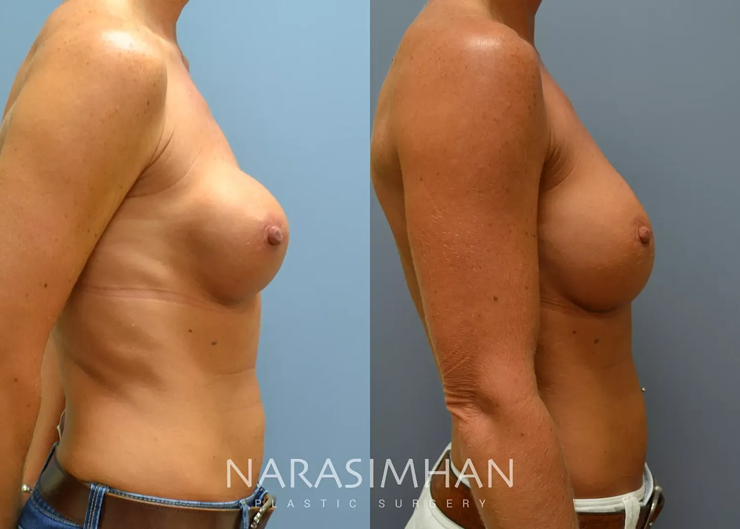 Breast Implant Revision Before & After