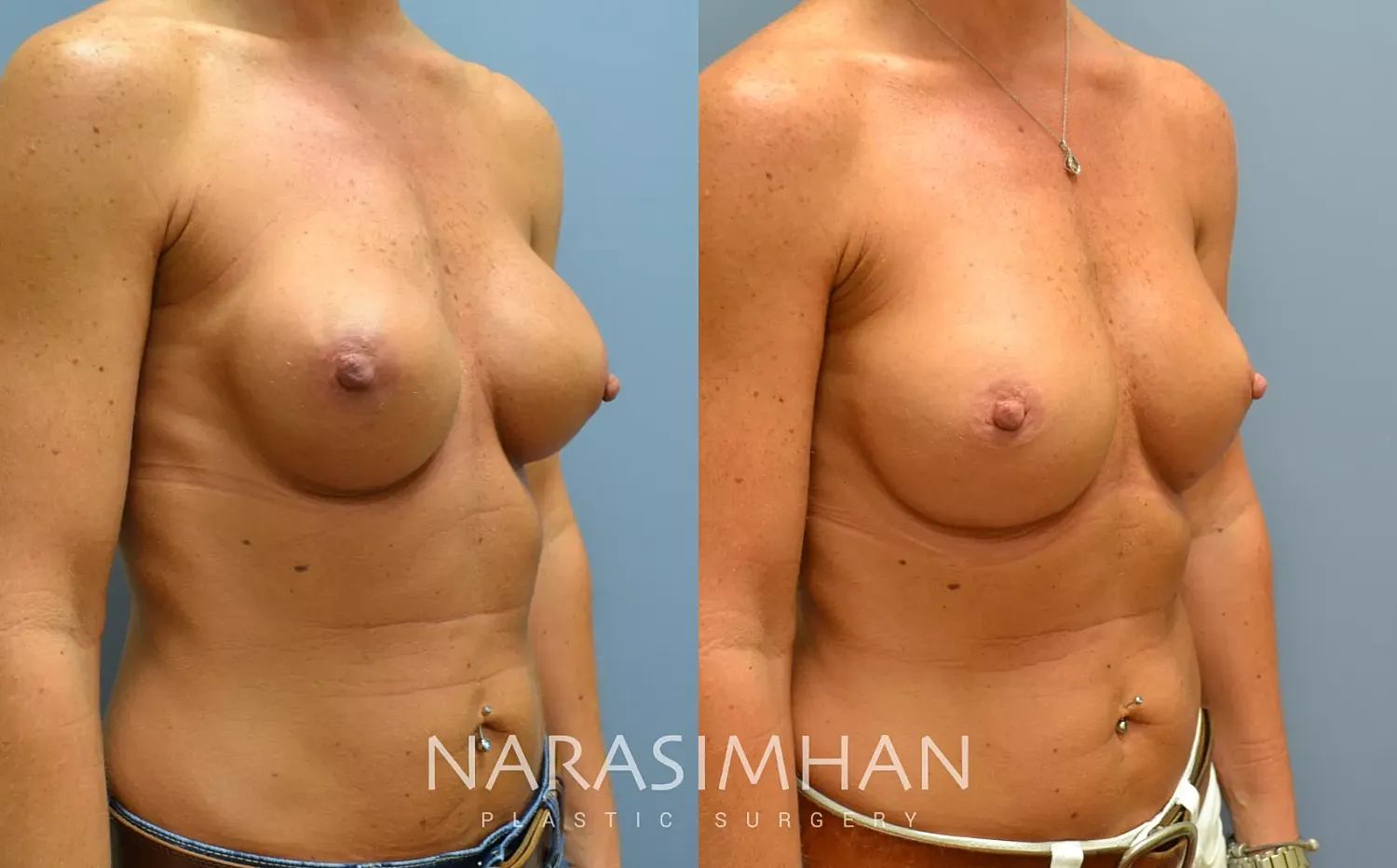 Breast Implant Revision Before & After
