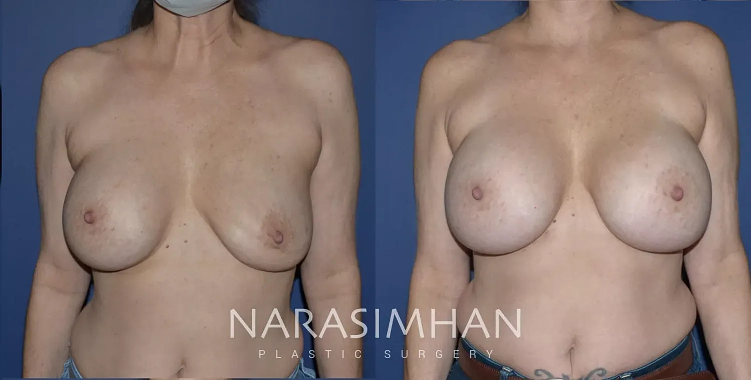 Breast Implant Revision Before & After