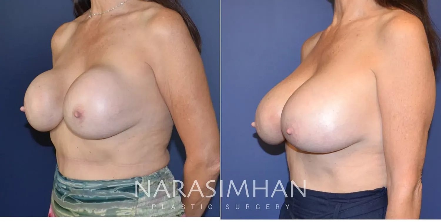 Breast Implant Revision Before & After