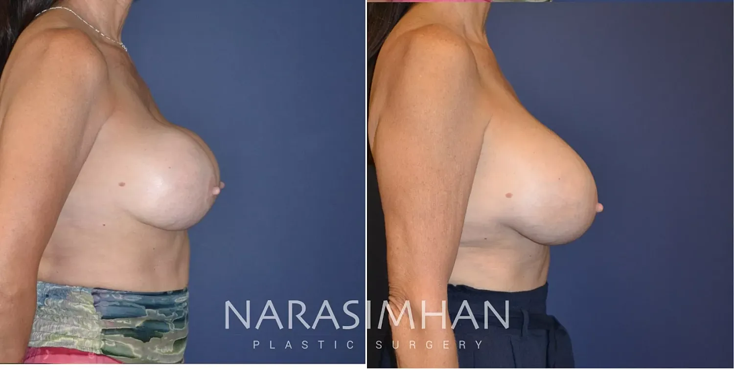 Breast Implant Revision Before & After