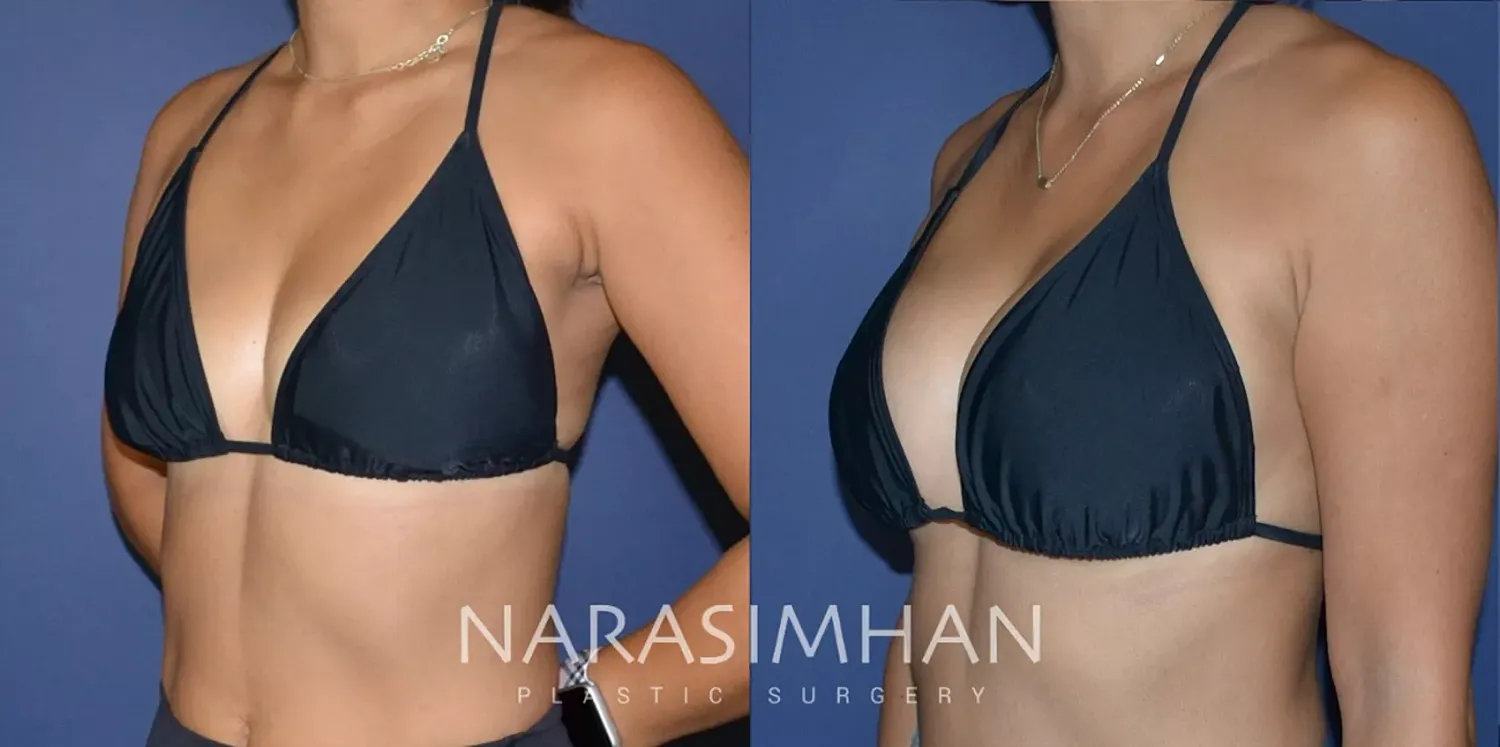 Breast Implant Revision Before & After