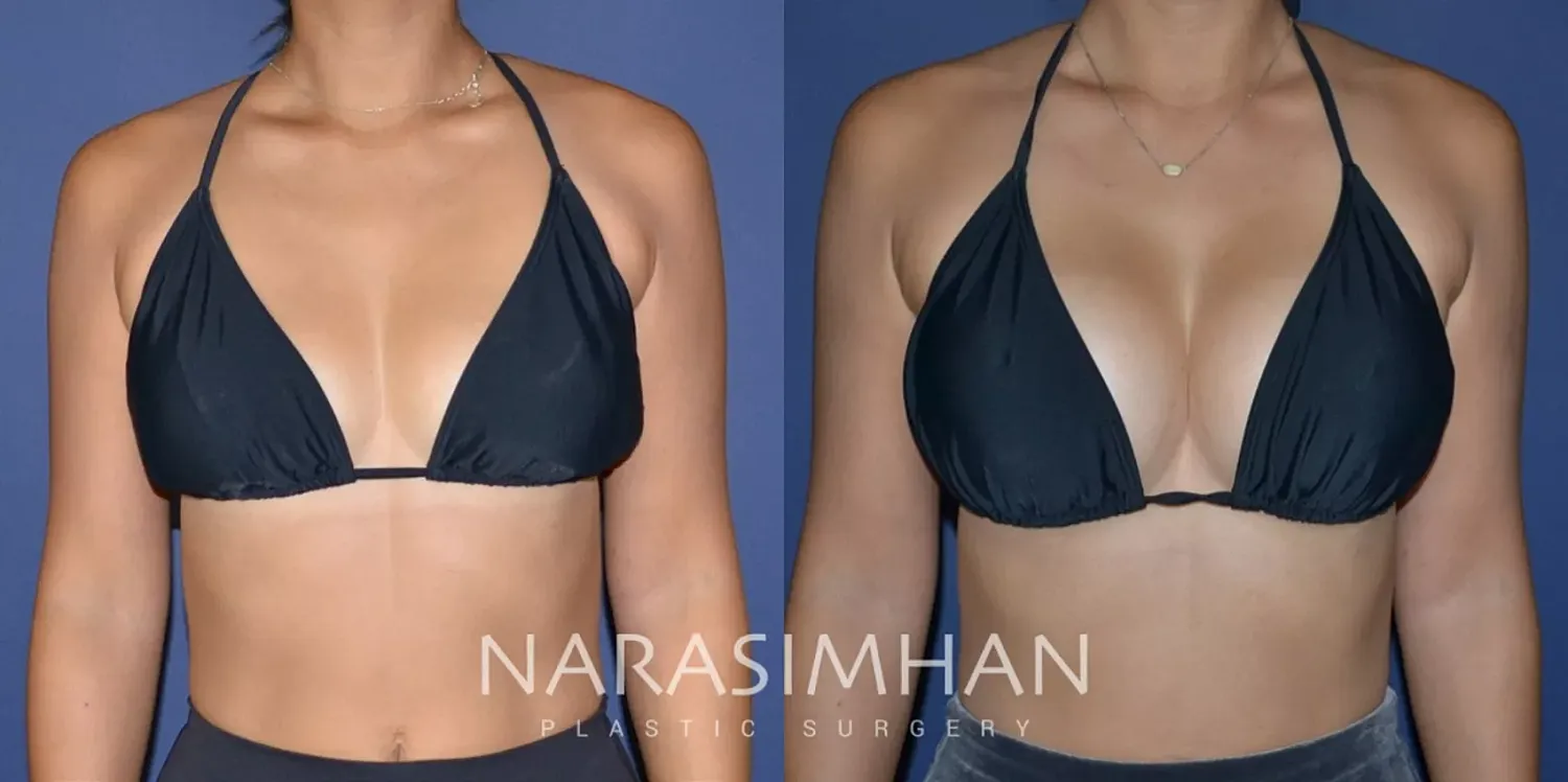 Breast Implant Revision Before & After