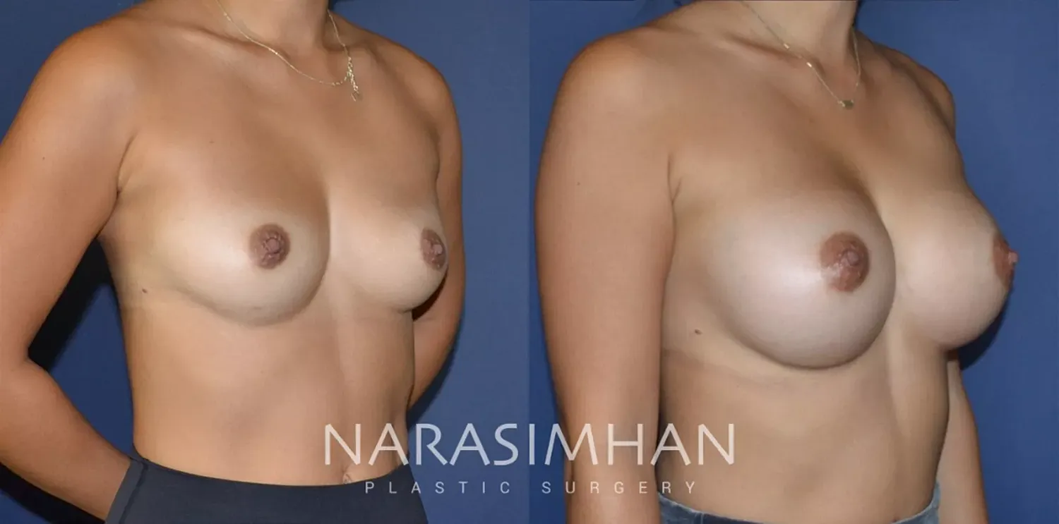 Breast Implant Revision Before & After