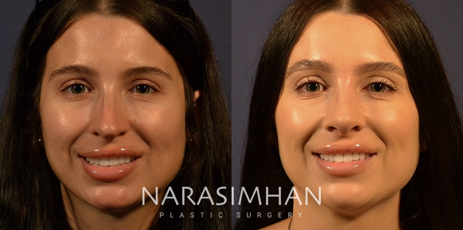 Revision Rhinoplasty Before & After
