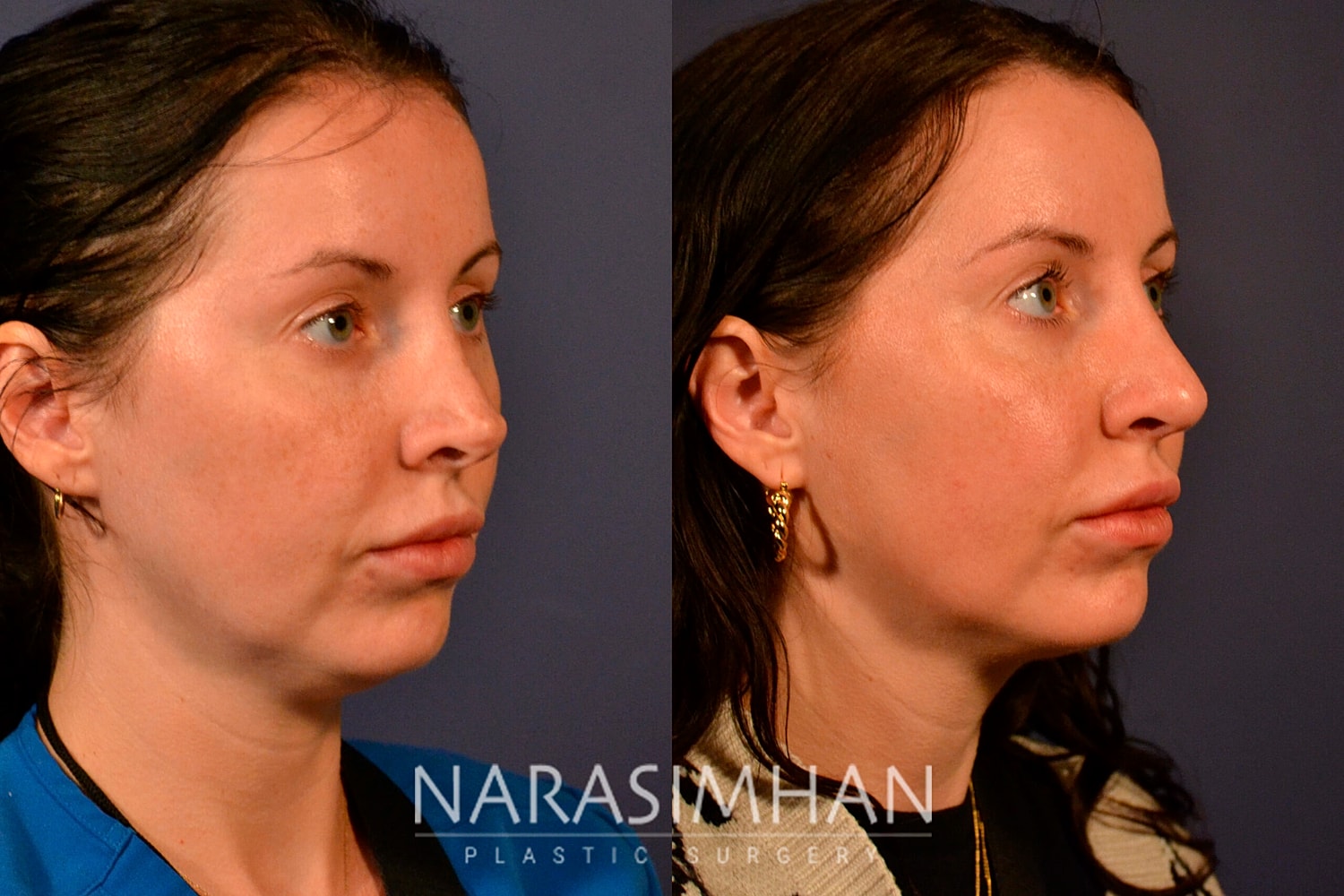 Revision Rhinoplasty Before & After