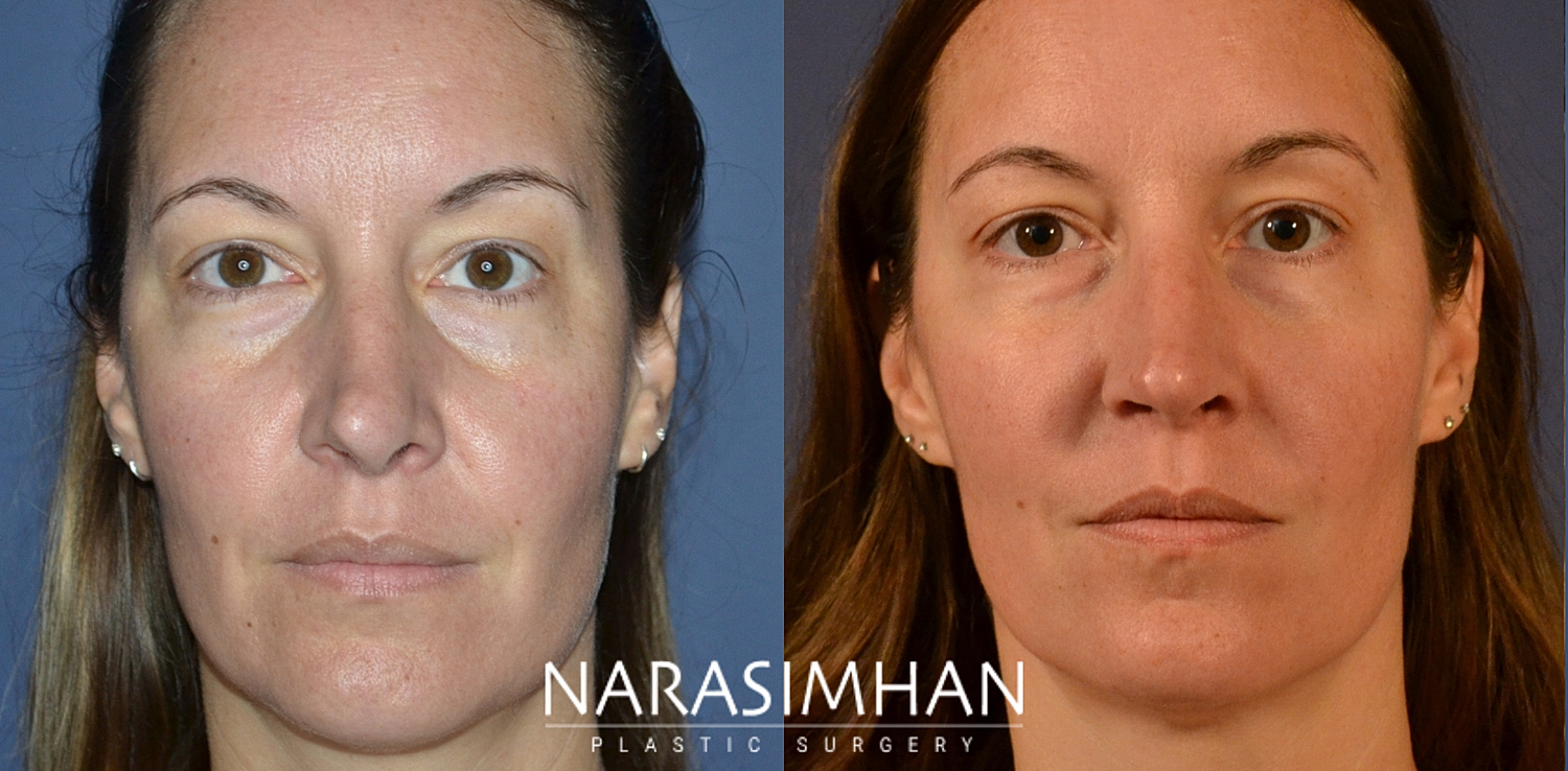 Revision Rhinoplasty Before & After