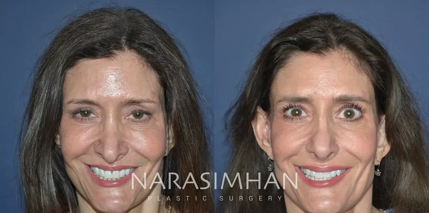 Revision Rhinoplasty Before & After