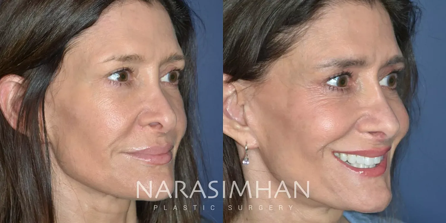 Revision Rhinoplasty Before & After