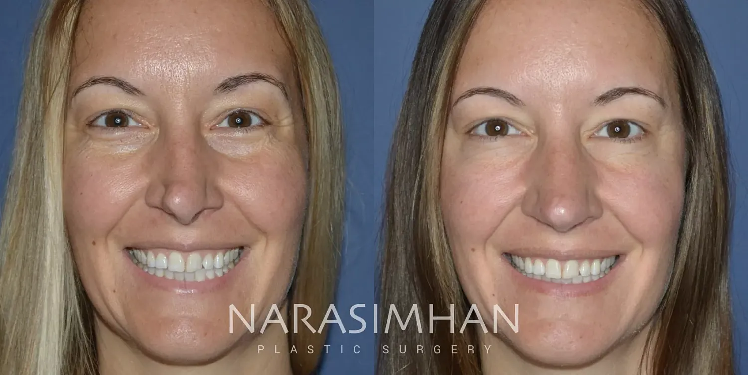 Revision Rhinoplasty Before & After