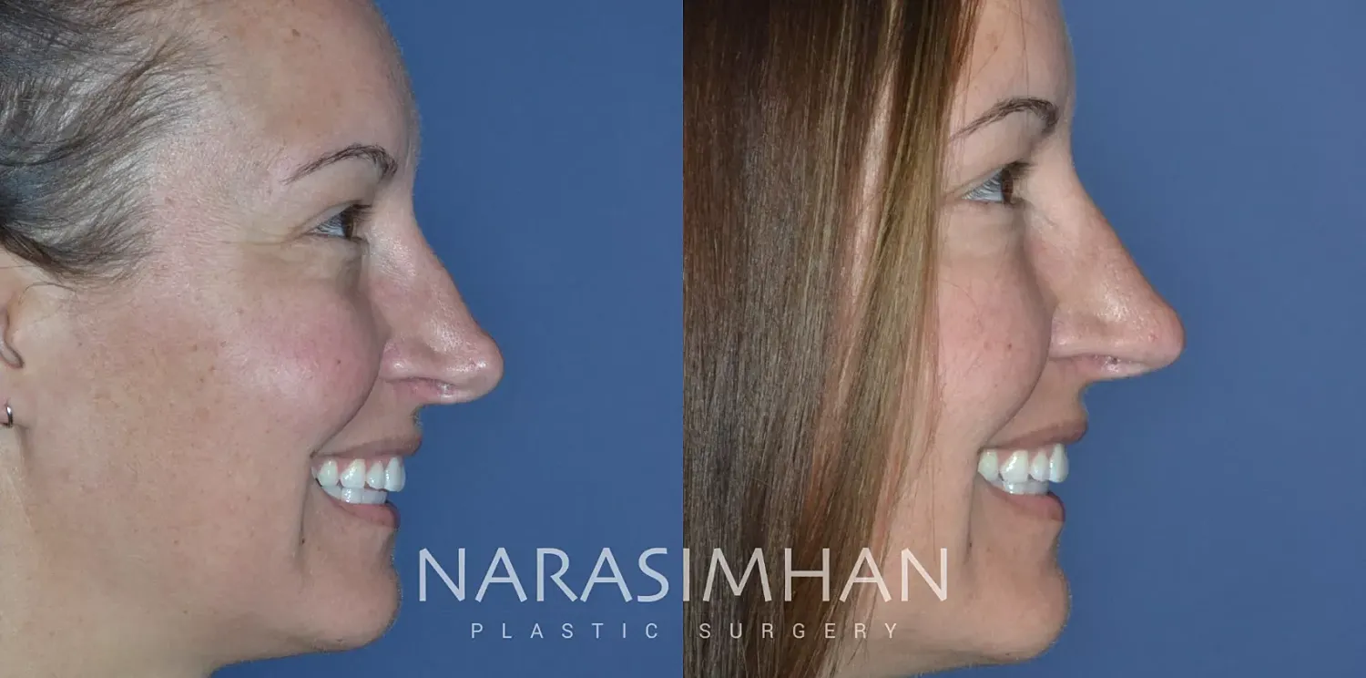Revision Rhinoplasty Before & After